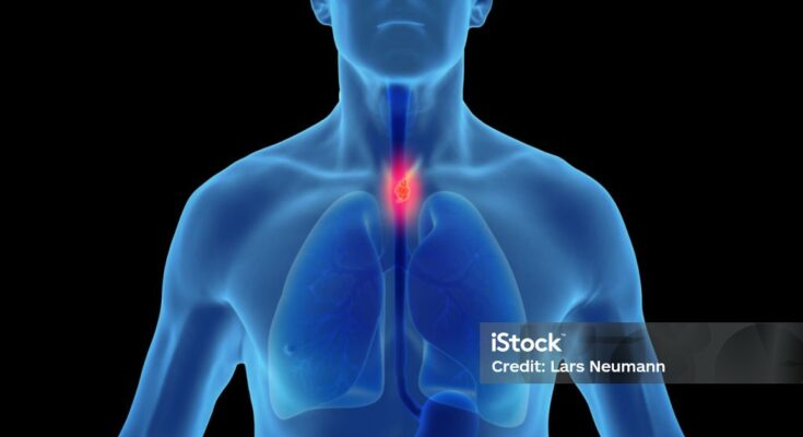 Esophageal Cancer: Causes and Symptoms